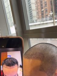 -碧莲盛·不剃发植发