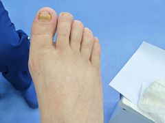 -Andrew指甲专科灰指甲·甲沟炎矫正·3D步态矫形鞋垫定制(浦三路店)