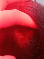 -碧莲盛·不剃发植发