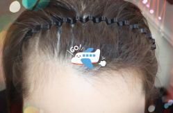 -大麦微针植发全国连锁