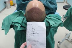 点击看大图 -大麦微针植发丨全国连锁