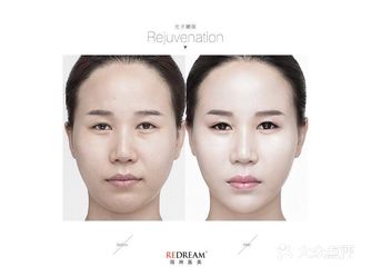 夏天就要到了，还不赶紧来做光子嫩肤？