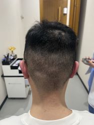 体验后-大麦微针植发全国连锁