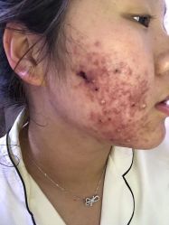 -苗方清颜专业祛痘