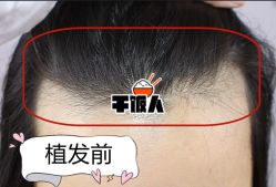 -大麦微针植发全国连锁