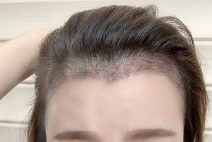 -大麦微针植发丨全国连锁