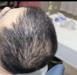 -大麦微针植发全国连锁