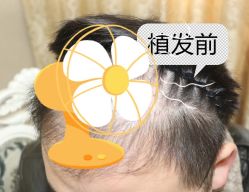 -大麦微针植发全国连锁