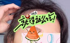 -大麦微针植发全国连锁