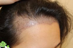 -大麦微针植发丨全国连锁