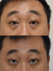 -广州健丽·去眼袋医疗美容机构