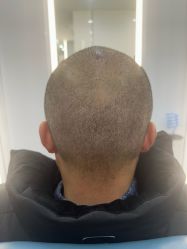 体验后-大麦微针植发全国连锁