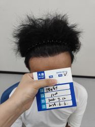 -大麦微针植发全国连锁