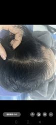 -大麦微针植发全国连锁