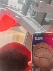 -碧莲盛·不剃发植发