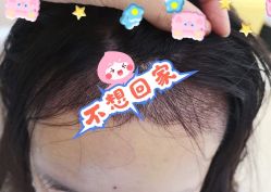 -大麦微针植发全国连锁