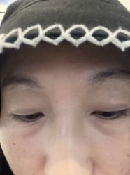 -天津健丽·去眼袋医疗美容机构