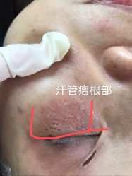 -爱莎扁平疣·汗管瘤·斑痣中心
