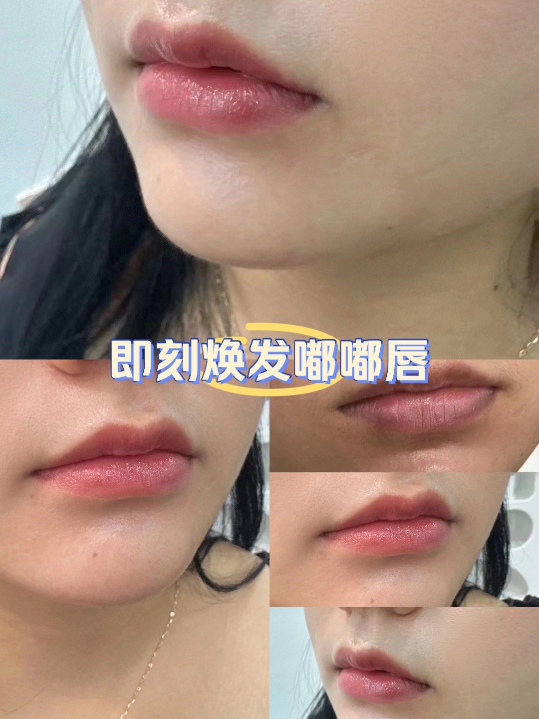 小姐姐一个月恢复完的状态非常自然好看🤩