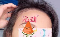 -大麦微针植发全国连锁