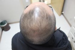 点击看大图 -大麦微针植发丨全国连锁