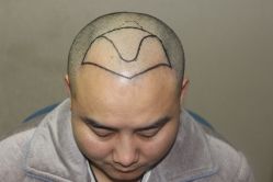 体验前-大麦微针植发全国连锁