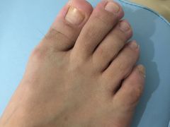 -世龙世家灰指甲·甲沟炎·跖疣护理·修脚(东江湾路店)