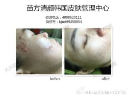 点击看大图 -苗方清颜痘肌研究所