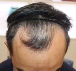 -大麦微针植发丨全国连锁