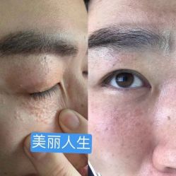 -美丽人生祛斑扁平疣汗管瘤中心