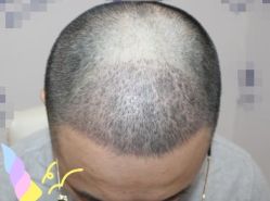 -大麦微针植发丨全国连锁