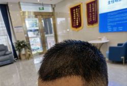 点击看大图 -碧莲盛·不剃发植发
