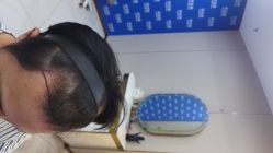 -碧莲盛不剃发植发
