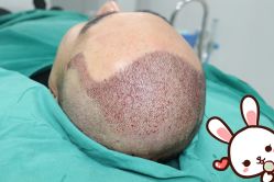 点击看大图 -大麦微针植发丨全国连锁