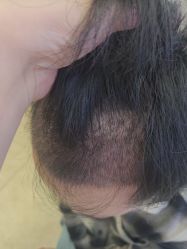 -大麦微针植发全国连锁