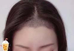 -大麦微针植发丨全国连锁