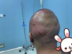 点击看大图 -大麦微针植发丨全国连锁