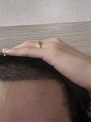 -大麦微针植发丨全国连锁