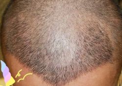 -大麦微针植发丨全国连锁