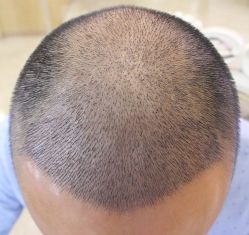 -大麦微针植发丨全国连锁