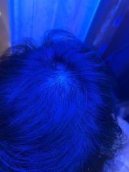 -碧莲盛·不剃发植发