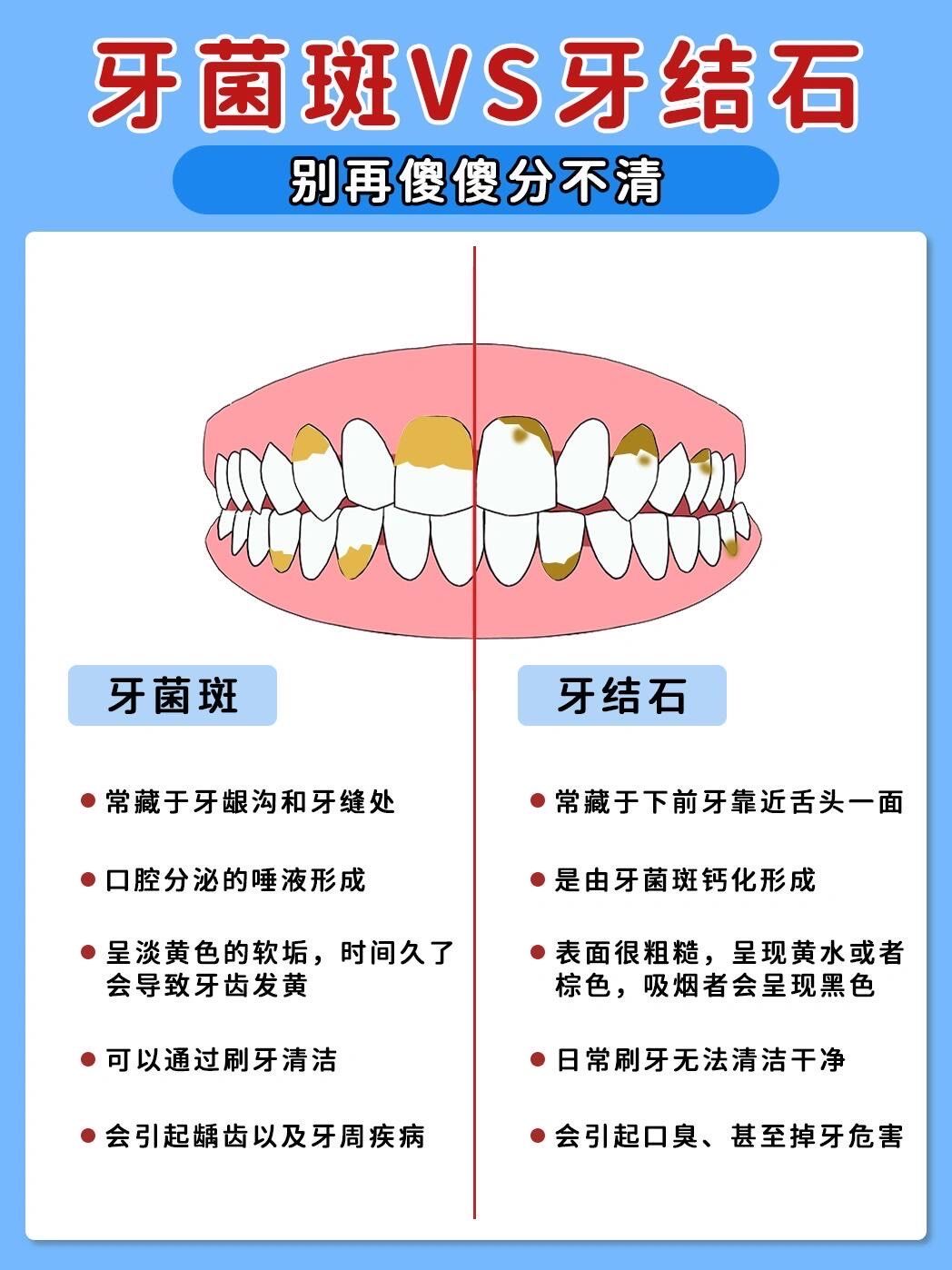 牙菌斑?牙结石?别再每天无效清洁了!