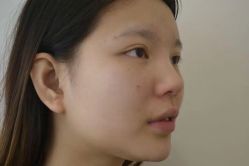 体验前-南宁维密整形·王敦华眼鼻整复中心