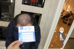 -大麦微针植发丨全国连锁