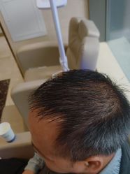 -碧莲盛·不剃发植发