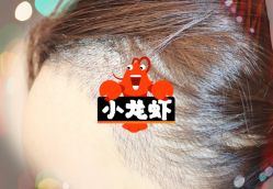 -大麦微针植发全国连锁