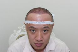 点击看大图 -大麦微针植发丨全国连锁