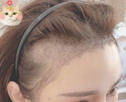 -大麦微针植发丨全国连锁