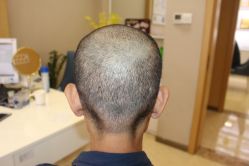 -大麦微针植发丨全国连锁