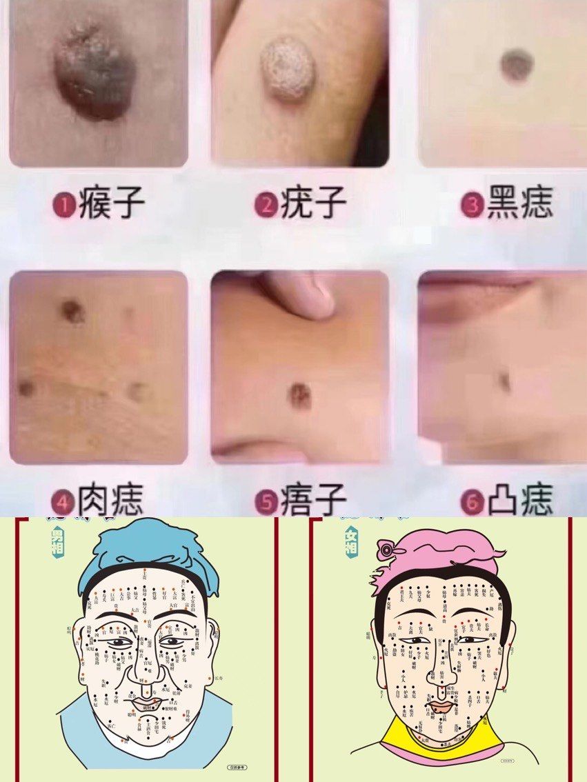 为什么长痦子 为什么长痦子